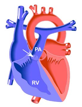 Pulmonary Stenosis